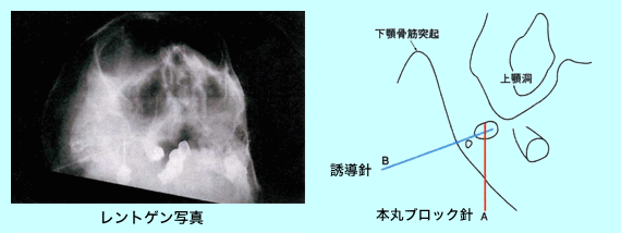 ガッセルブロック（麻酔によるブロック注射）