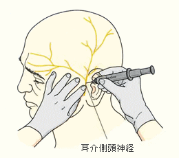 耳介側頭神経