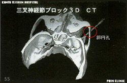 三叉神経節ブロック3D-CT／ヘリカルCTによる骨標本での卵円孔と針の関係