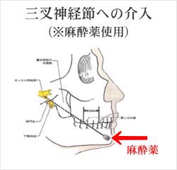 麻酔薬による三叉神経節介入
