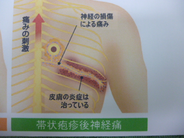 疱疹 後 神経痛 帯状 【医師監修】帯状疱疹が治ったのにまだ痛い。帯状疱疹後神経痛ってどんな病気？